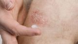 Krém na kožní choroby Dermatopan 200 ml